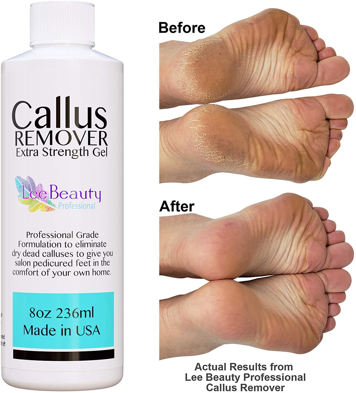 Lee Beauty's Callus Remover For Feet Eliminates Dead Skin Fast – StyleCaster