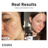 Before and after about CosRX Niacinamide 15% Face Serum 0.67 oz