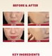 Before and after results of using K-Secret Snail Mucin Cream for redness and skin repair
