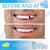 Instant Smile Thermal Fitting Temporary Tooth Replacement Fitting Beads