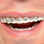 Billy Bob Fool All Braces Fun Teeth