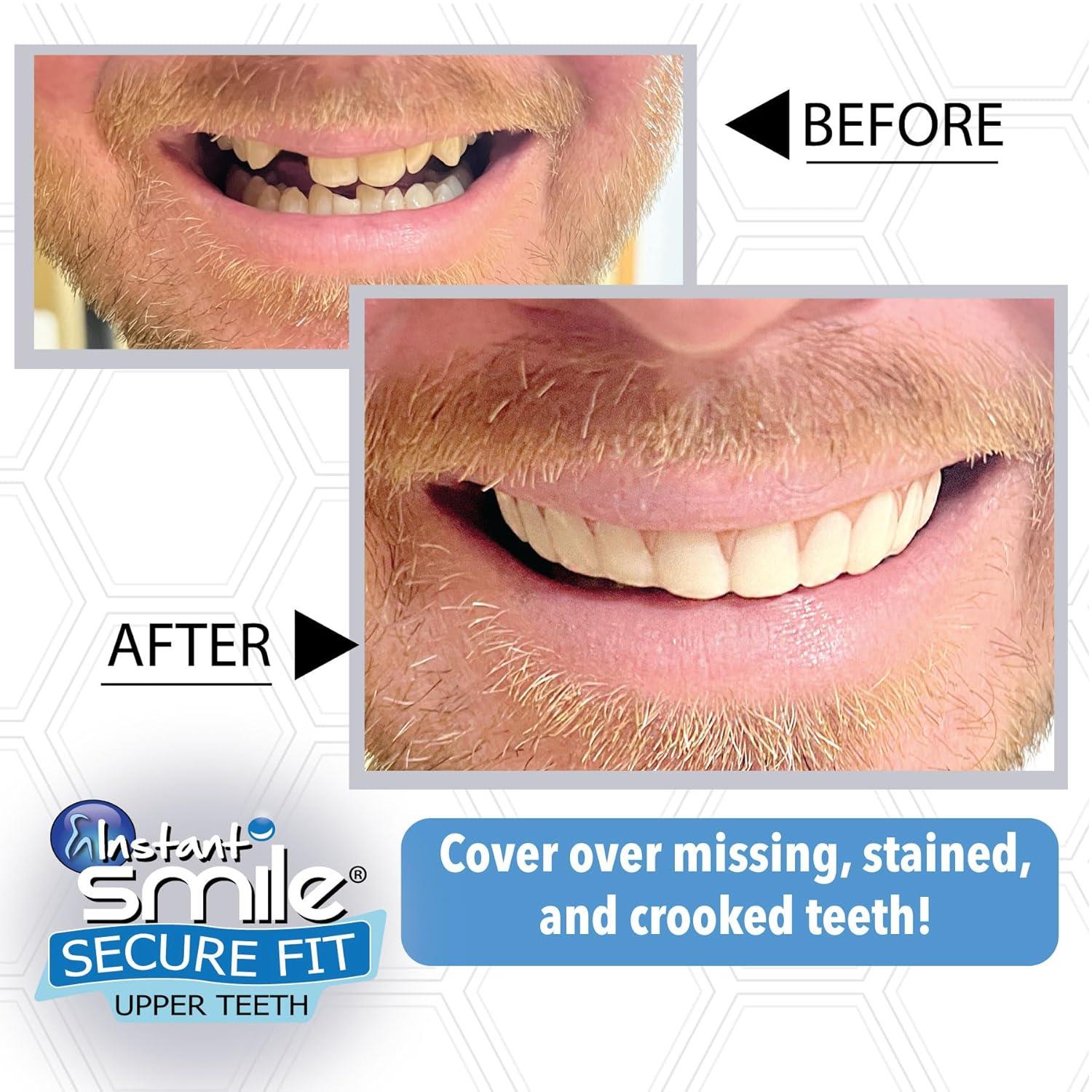 Instant Smile Product Instant Smile Secure Fit Upper Teeth Veneers ...