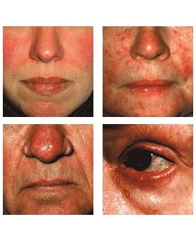 Rosacea 101