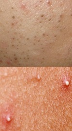 Blackheads vs Whiteheads