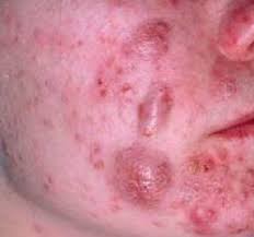 Cystic Acne