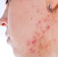 Hormonal Acne