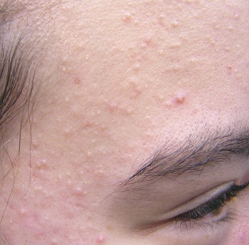 Acne Part 2: Types of Acne