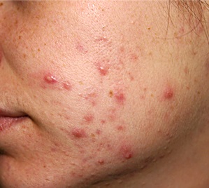 Moderate Acne