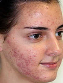 Severe Acne