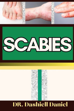 Scabies: Expert Guide To Understanding Scabies Causes, Symptoms, Preventing, Treatment for optimal wellness Scabies: Expert Guide To Understanding Scabies Causes, Symptoms, Preventing, Treatment for optimal wellness
