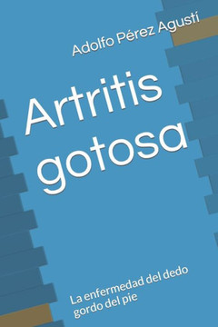 Artritis gotosa: La enfermedad del dedo gordo del pie