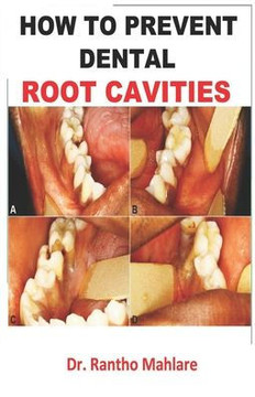 How to Prevent Dental Root Cavities