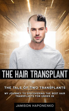 The Hair Transplant: The Tale Of Two Transplants my journey to discovering the best transplants for under 2k
