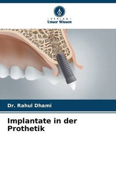 Implantate in der Prothetik