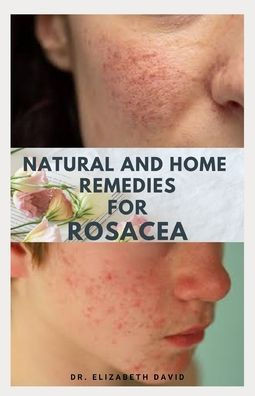 Natural and Home Remedies for Rosacea: A Self Help Guide To Completely Prevent and Treat Rosacea