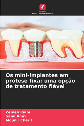 Os mini-implantes em prótese fixa: uma opção de tratamento fiável