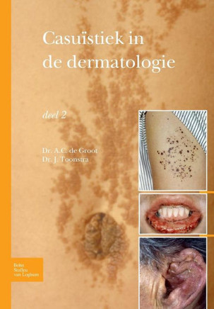 Casu?stiek in de Dermatologie - Deel 2 Casu?stiek in de Dermatologie - Deel 2