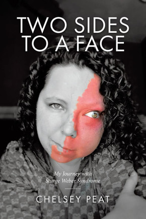 Two Sides to a Face : My Journey with Sturge Weber Syndrome