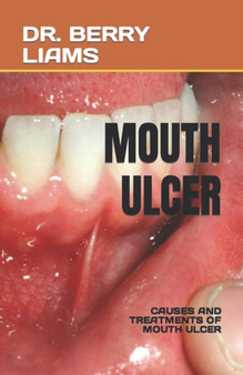 Mouth Ulcer : Causes and Treatments of Mouth Ulcer