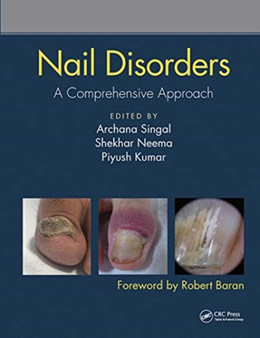 Nail Disorders : A Comprehensive Approach by Archana Singal - Paperback