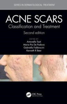 Acne Scars : Classification and Treatment, Second Edition by Antonell Tosti - Hardback