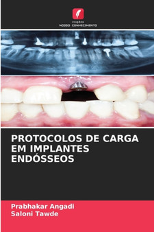 Protocolos de Carga Em Implantes Endosseos by Prabhakar Angadi - Paperback