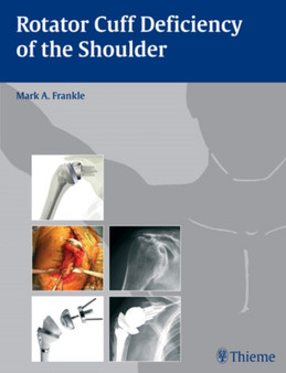 Rotator Cuff Deficiency of the Shoulder by Mark Frankle - Hardback