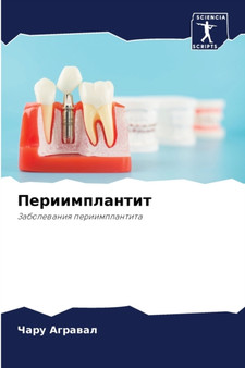 Периимплантит by Чару Аграва - Paperback