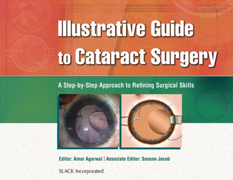 Illustrative Guide to Cataract Surgery : A Step-by-Step Approach to Refining Surgical Skills by Amar Agarwal - Hardback Illustrative Guide to Cataract Surgery : A Step-by-Step Approach to Refining Surgical Skills by Amar Agarwal - Hardback