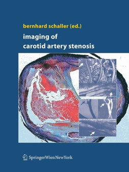 Imaging of Carotid Artery Stenosis by Bernhard Schaller - Paperback