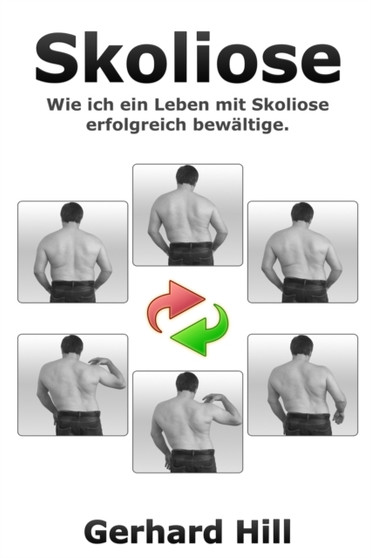 Skoliose : Wie ich ein Leben mit Skoliose erfolgreich bewaltige