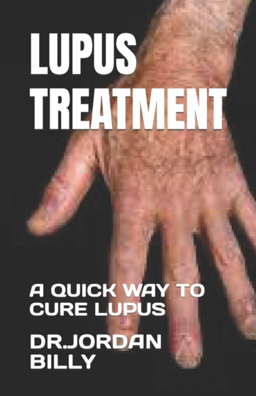 Lupus Treatment : A Quick Way to Cure Lupus