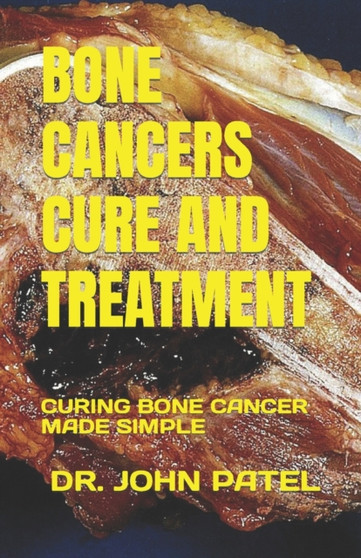 Bone Cancers Cure and Treatment : Curing Bone Cancer Made Simple