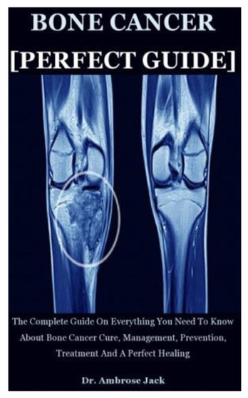 Bone Cancer [Perfect Guide] : The Complete Guide On Everything You Need To Know About Bone Cancer Cure, Management, Prevention, Treatment And A Perfect Healing