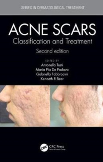 Acne Scars : Classification and Treatment, Second Edition by Antonell Tosti - Hardback