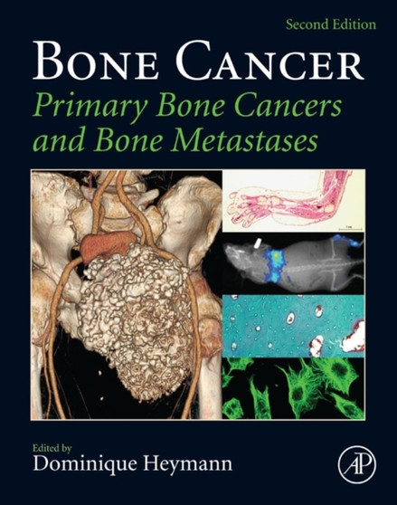 Bone Cancer : Primary Bone Cancers and Bone Metastases by Dominique Heymann - Hardback