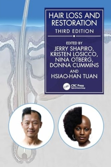 Hair Loss and Restoration by Jerry Shapiro - Hardback