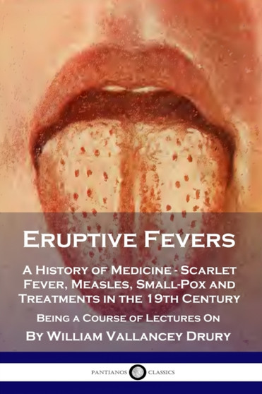 Eruptive Fevers : A History of Medicine - Scarlet Fever, Measles, Small-Pox and Treatments in the 19th Century - Being a Course of Lectures On by William Vallancey Drury - Paperback