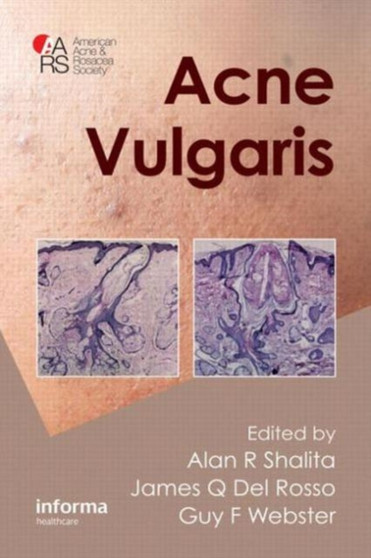 Acne Vulgaris by Alan R. Shalita - Hardback