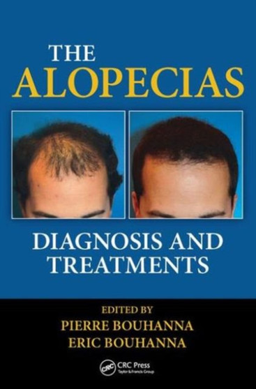 The Alopecias : Diagnosis and Treatments by Pierre Bouhanna - Hardback