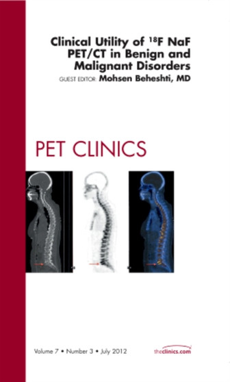 Clinical Utility of 18NaF PET/CT in Benign and Malignant Disorders, An Issue of PET Clinics : Volume 7-3 by Mohsen Beheshti - Hardback