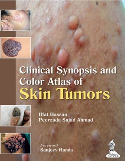 Clinical Synopsis and Color Atlas of Skin Tumors by Iffat Hassan - Paperback