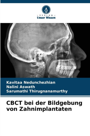 CBCT bei der Bildgebung von Zahnimplantaten by Kavitaa Nedunchezhian - Paperback