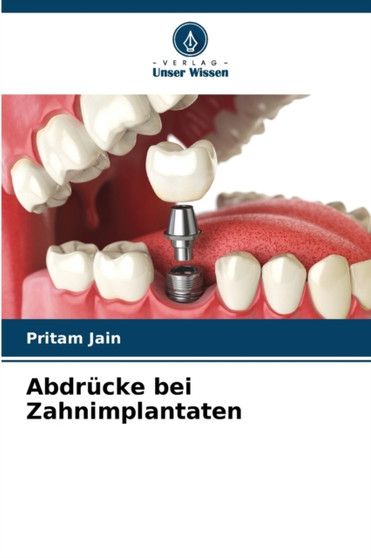 Abdrucke bei Zahnimplantaten by Pritam Jain - Paperback