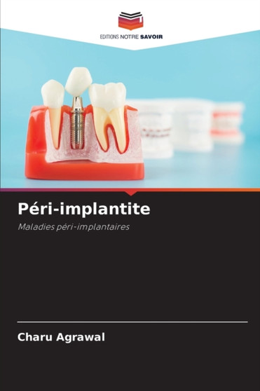 Peri-implantite by Charu Agrawal - Paperback