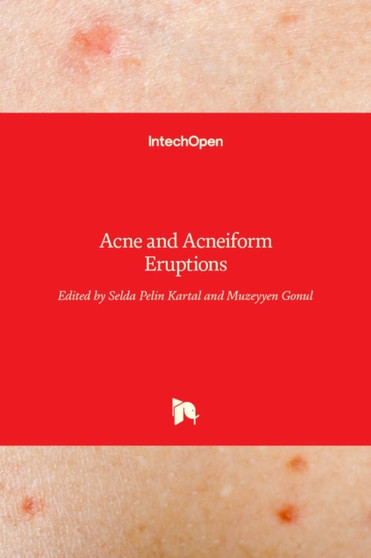 Acne and Acneiform Eruptions by Selda Pelin Kartal - Hardback
