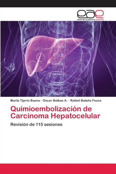 Quimioembolizacion de Carcinoma Hepatocelular by Marta Tijerin Bueno - Paperback