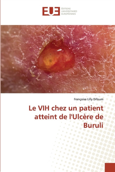 Le VIH chez un patient atteint de l'Ulcere de Buruli by Francoise Lilly Difoum - Paperback