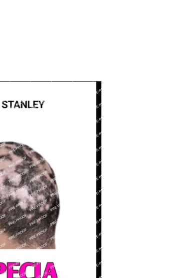 Alopecia areata : Surviving With and Treating Alopecia Areata by Dr Joseph Stanley - Paperback