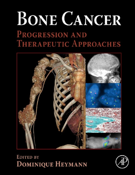 Bone Cancer : Progression and Therapeutic Approaches by Dominique Heymann - Hardback